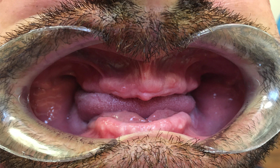 The patient lost his teeth at a very early age