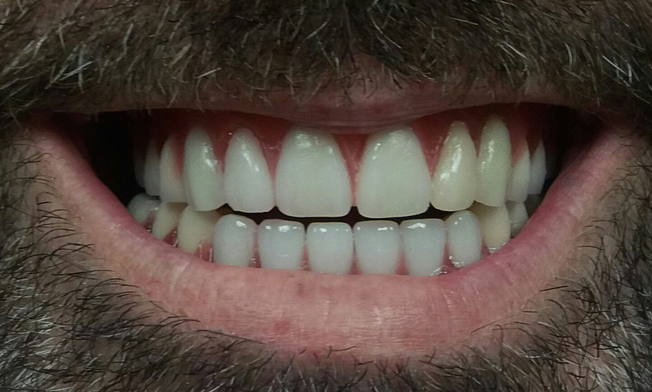 The patient lost his teeth at a very early age