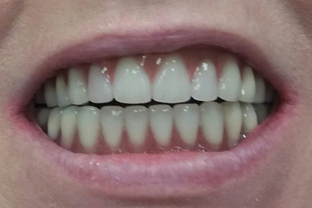 Poor oral hygiene