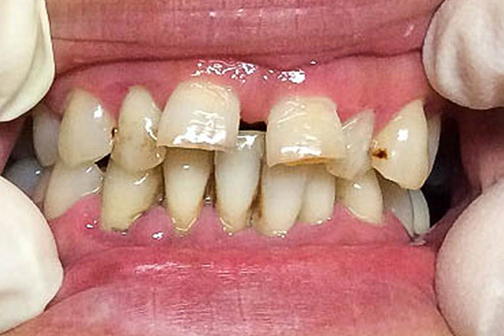 Periodontal gum disease