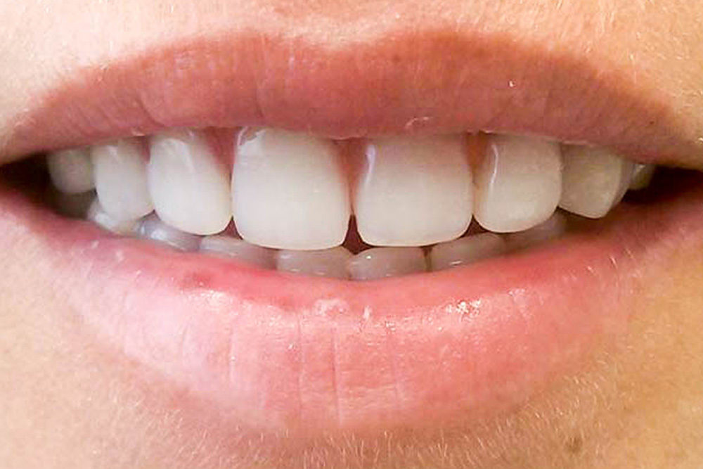 Periodontal gum disease