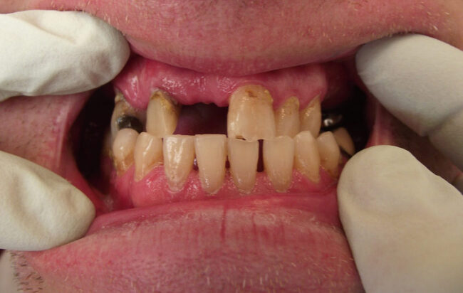 Parodontális megbetegedések esetén