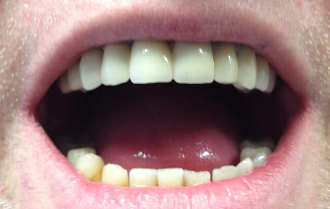 Parodontális megbetegedések esetén