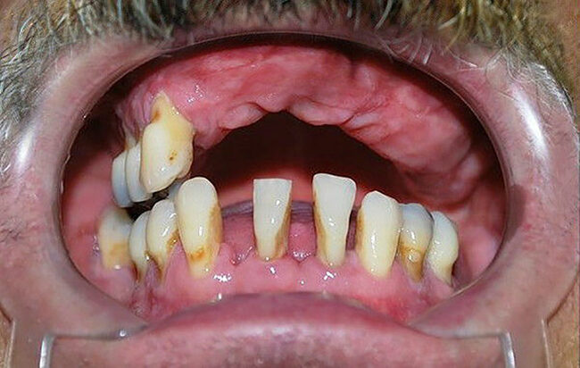 Teljes állcsont rehabilitáció