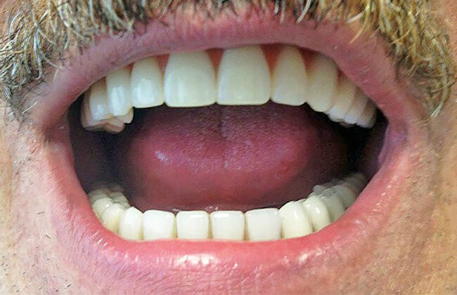 Restaurarea completă a maxilarului